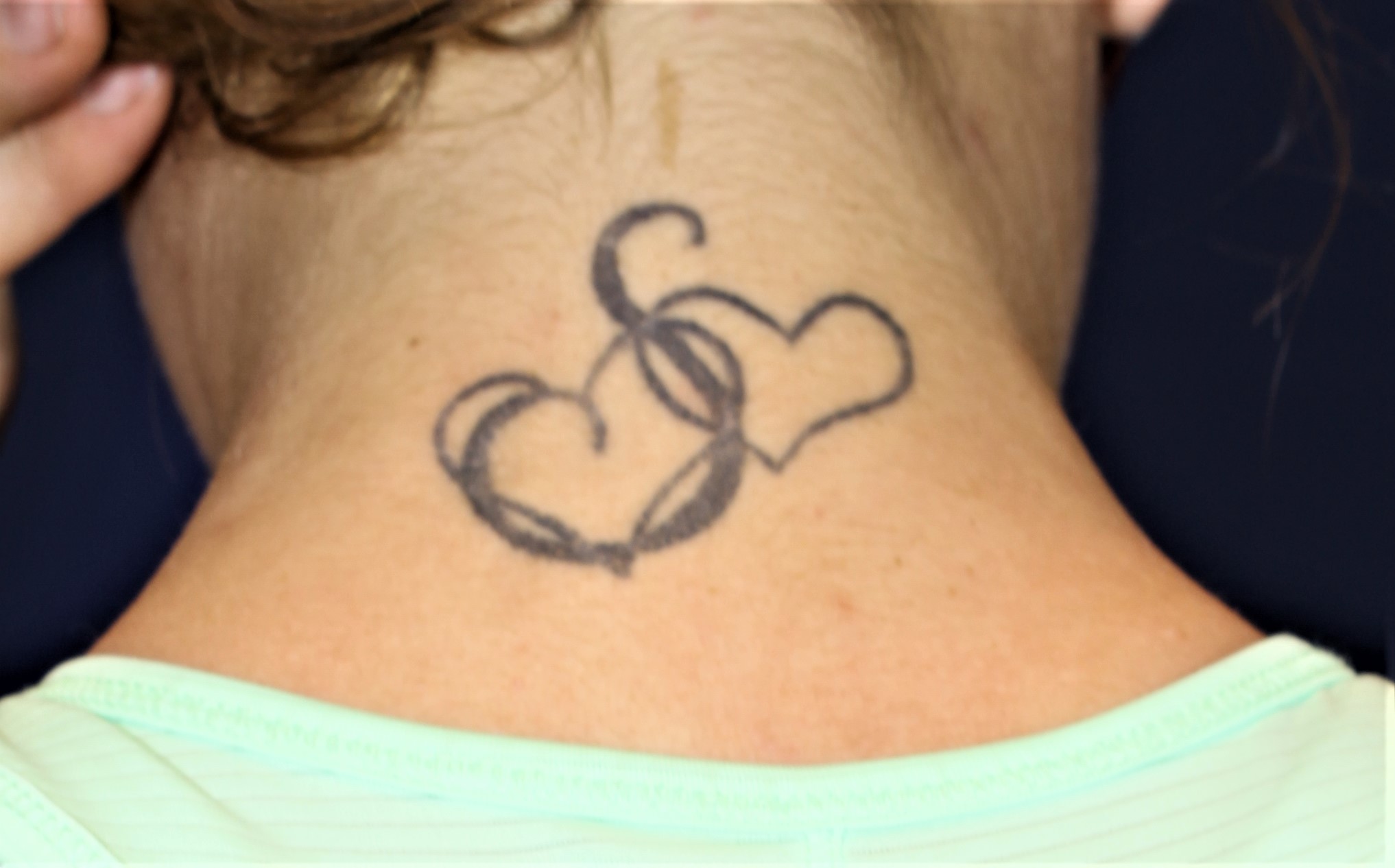 Tattoo Removal - Before & After Images